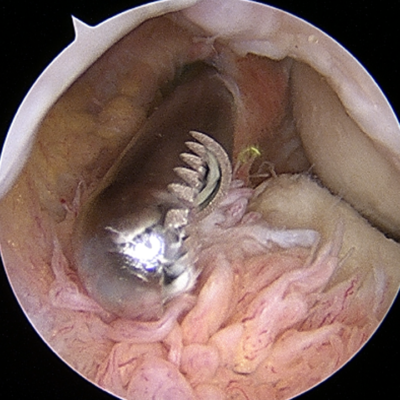 Elbow_Arthritis pro orthopedics and sports medicine