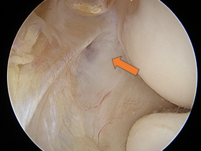 Elbow_TennisElbow pro orthopedics and sports medicine