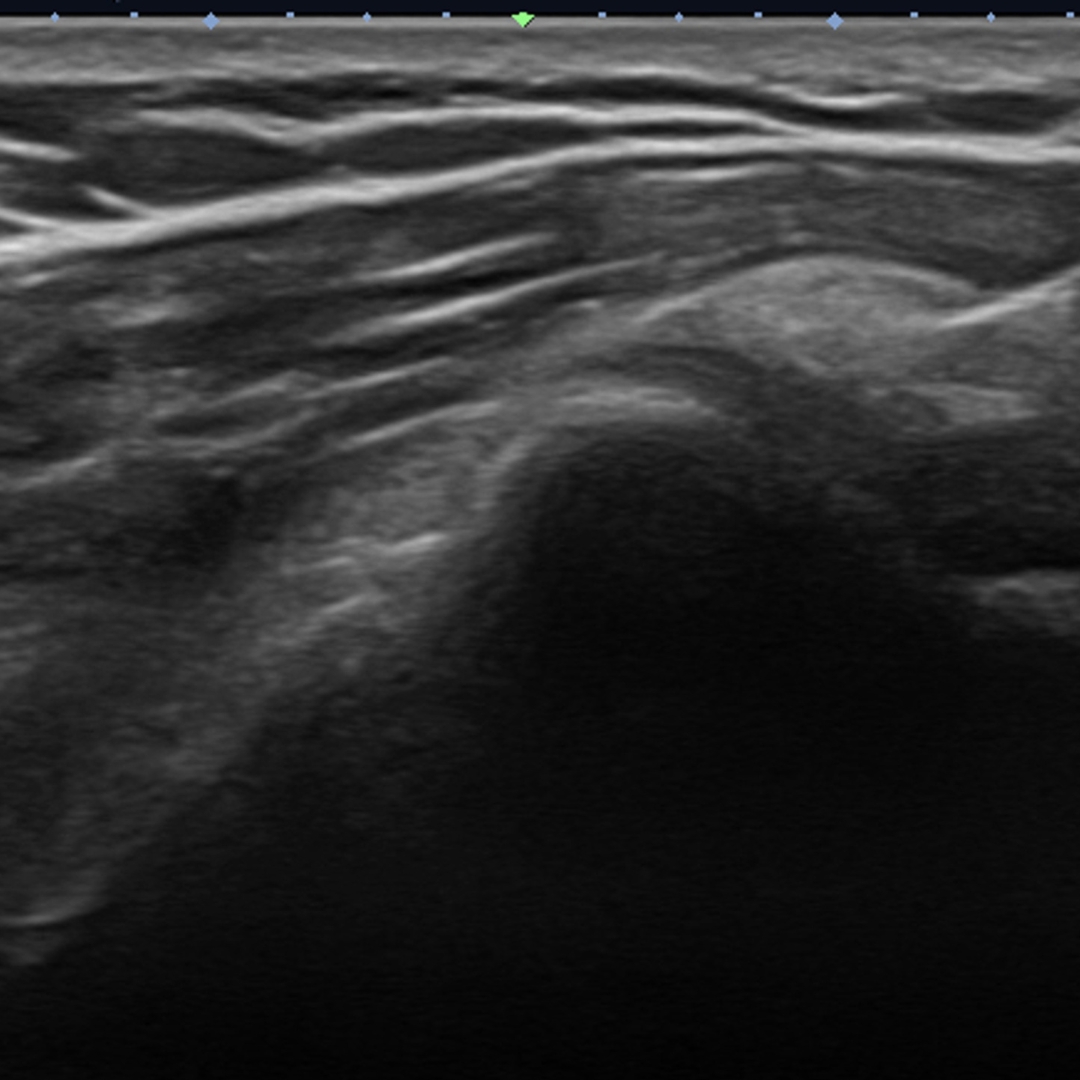 ULTRASOUND-GUIDED CALCIFICATION BARBOTAGE